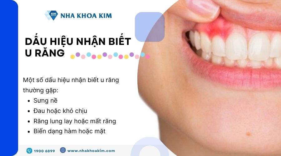 Dấu hiệu nhận biết u răng