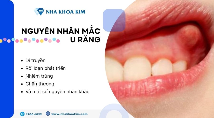Nguyên nhân mắc u răng