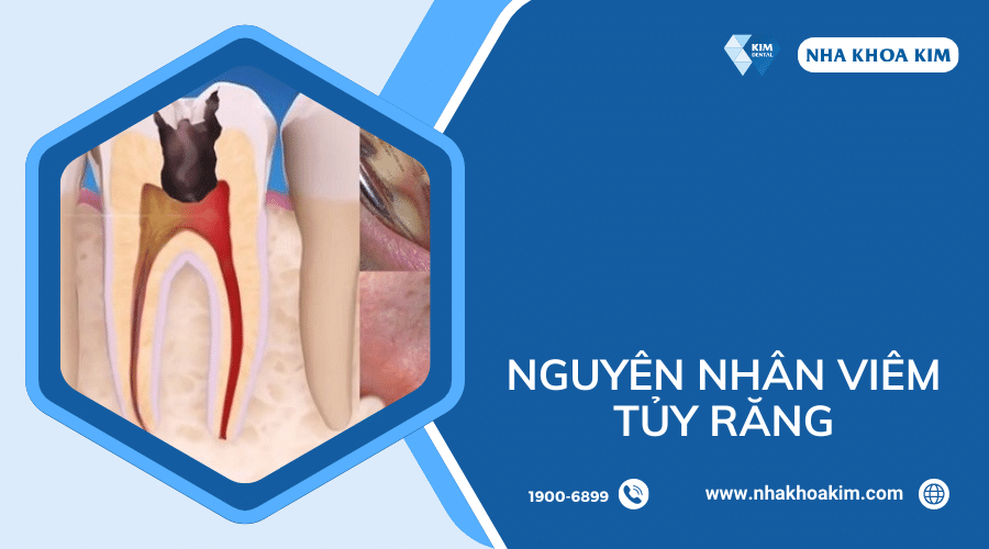 Nguyên nhân viêm tủy răng