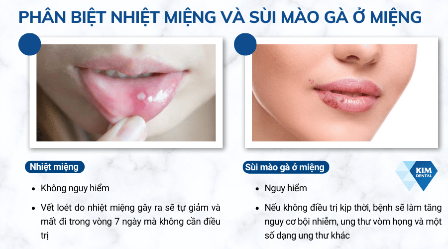 phân biệt sùi mào gà ở miệng với nhiệt miệng