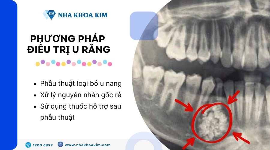 Phương pháp điều trị u răng
