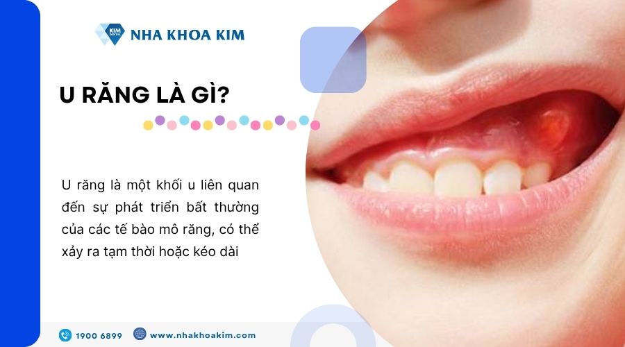 U răng là gì?
