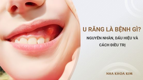 U răng là bệnh gì? Nguyên nhân, dấu hiệu và cách điều trị