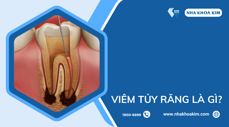 Viêm tủy răng là gì?