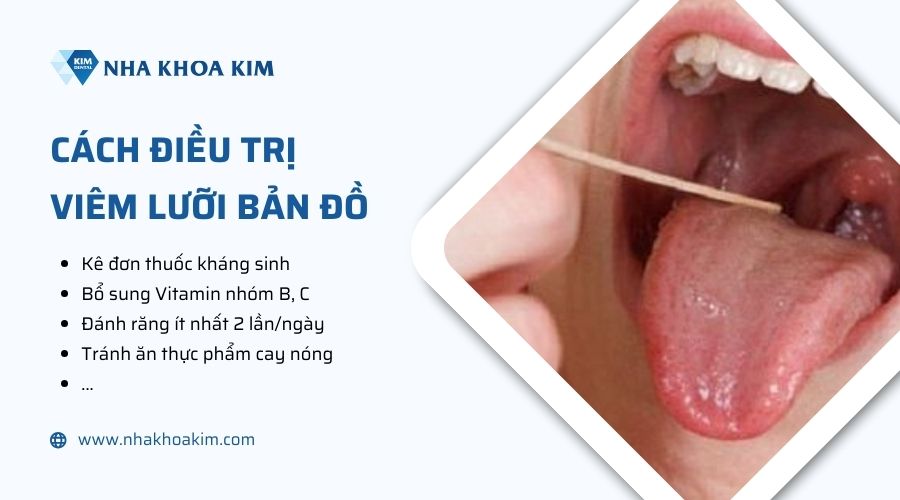 Điều trị viêm lưỡi bản đồ