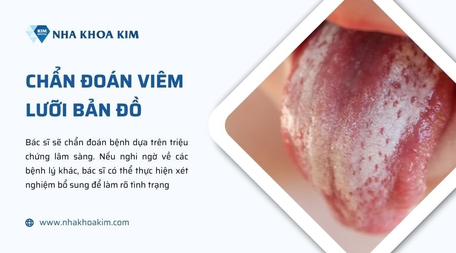 chẩn đoán lưỡi bị viêm hình bản đồ