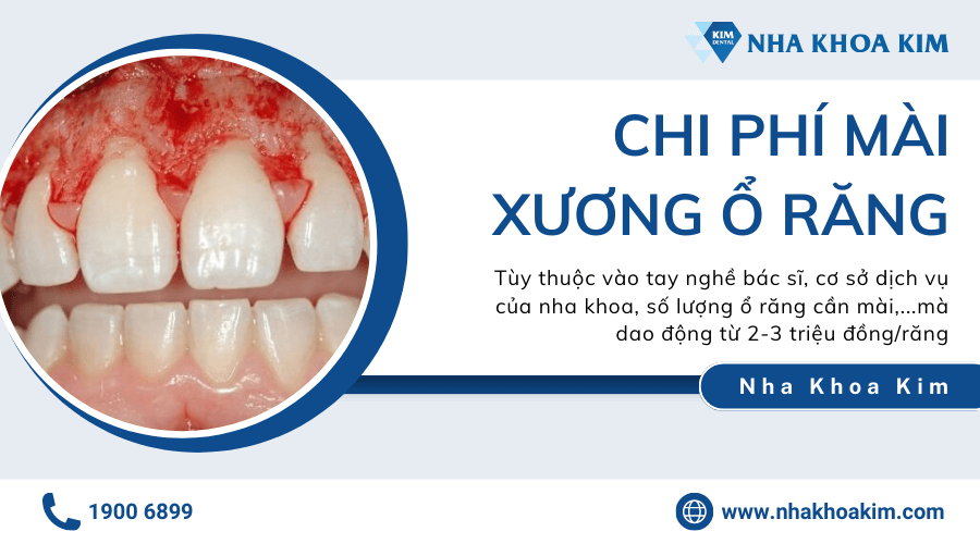 Chi phí mài xương ổ răng