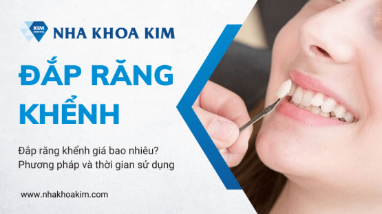 Đắp răng khểnh giá bao nhiêu? Phương pháp và thời gian sử dụng