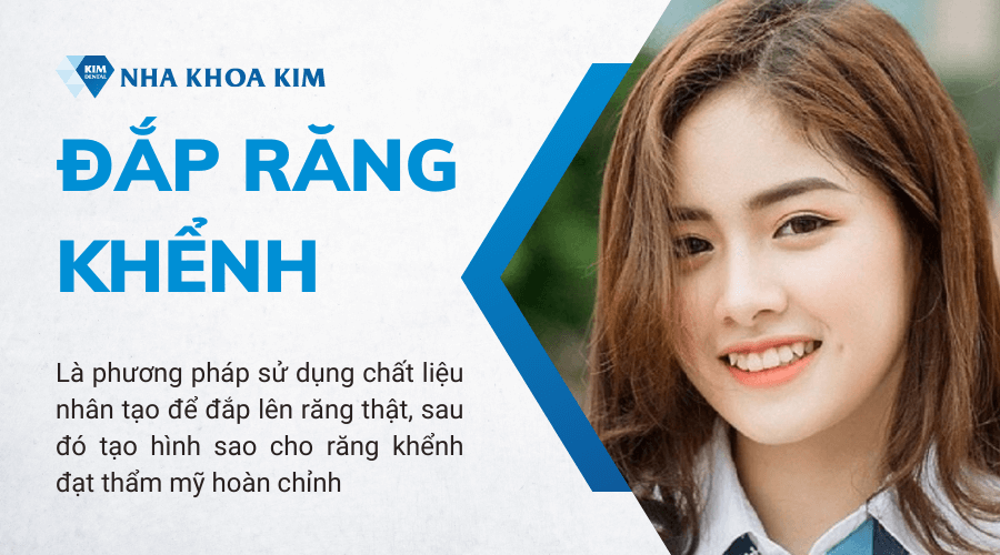 Răng khểnh là gì?