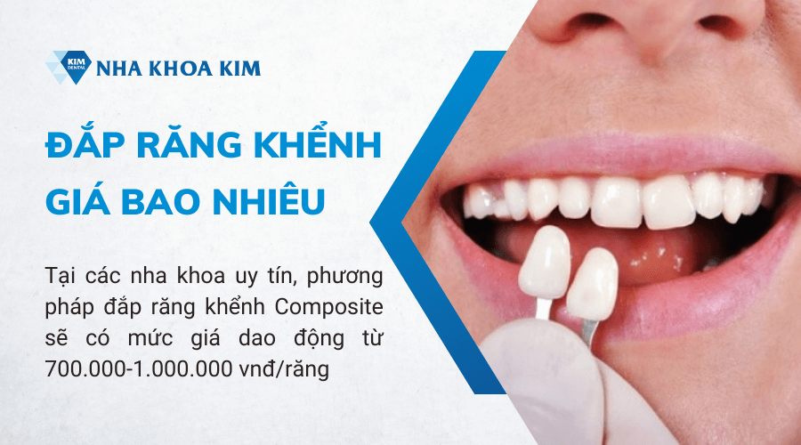 Đắp răng khểnh giá bao nhiêu?