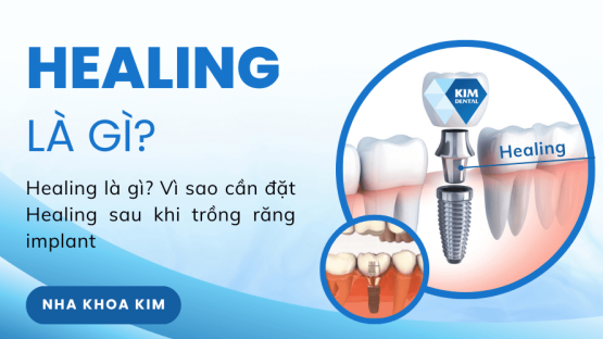 Healing là gì? Vì sao cần đặt Healing sau khi trồng răng implant