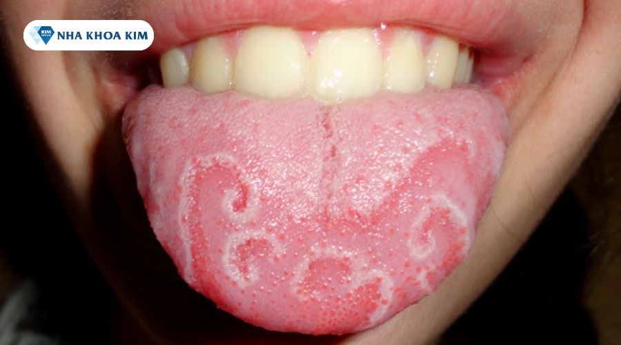 Hình ảnh viêm lưỡi bản đồ ở trẻ em