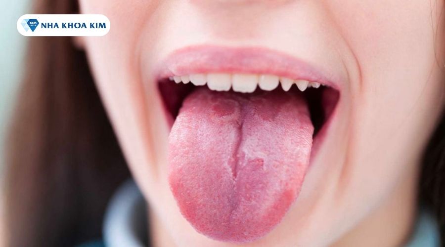 Hình ảnh viêm lưỡi bản đồ ở người lớn