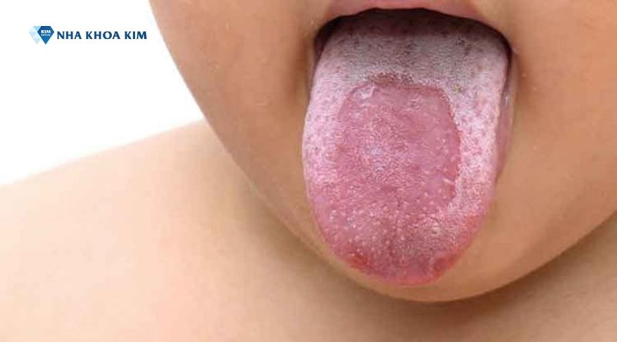 Bệnh lưỡi bản đồ ở trẻ em