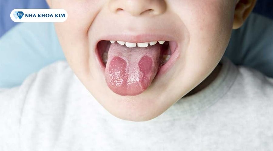Bệnh viêm lưỡi hình bản đồ