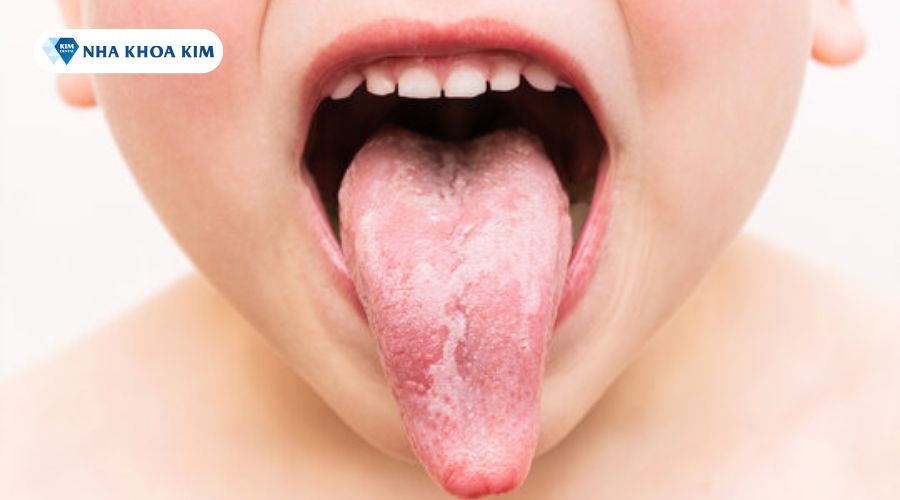 hình ảnh triệu chứng của bệnh về lưỡi bản đồ