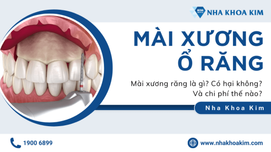 Mài xương răng là gì? Có hại không? Và chi phí thế nào?