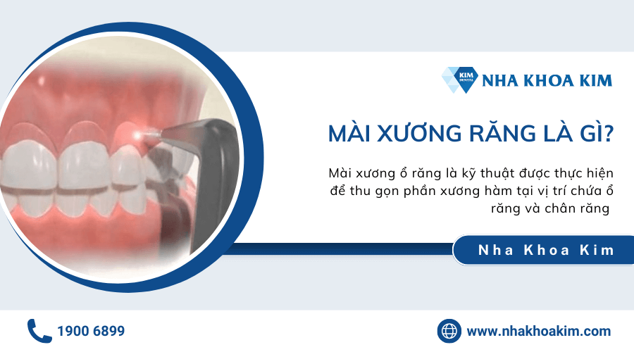 Mài xương răng là gì?