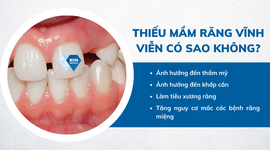 Thiếu mầm răng vĩnh viễn có sao không?