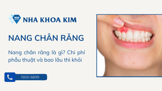 Nang chân răng là gì? Có nguy hiểm không?