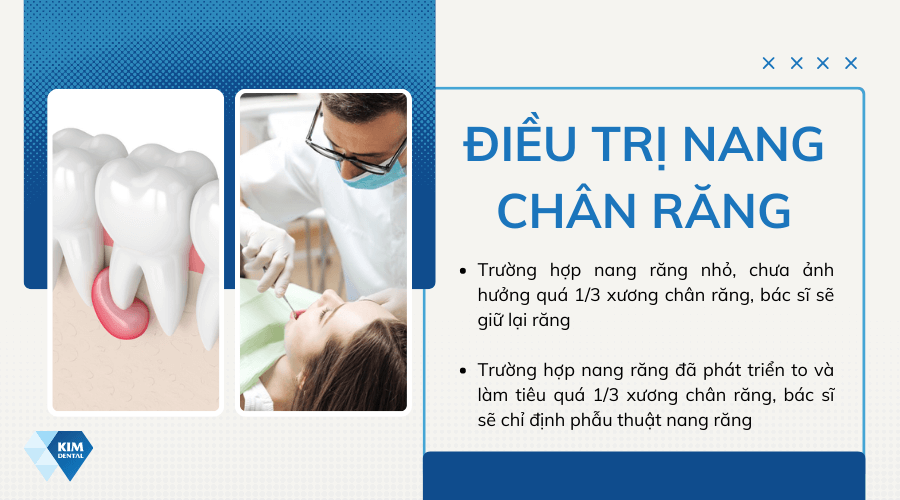 Điều trị nang chân răng như thế nào?