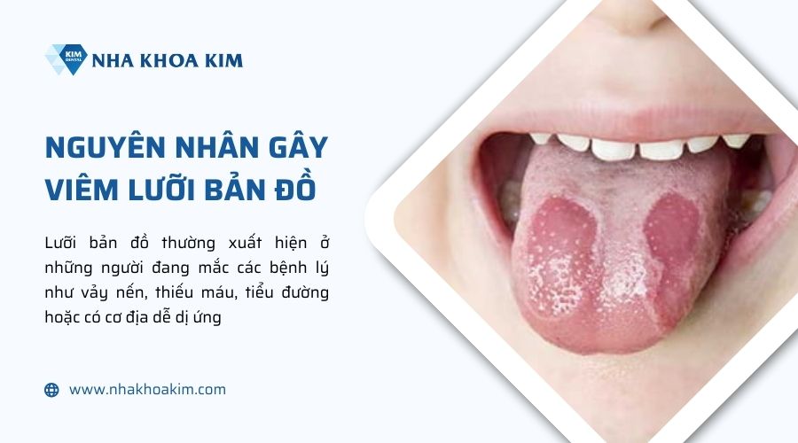 nguyên nhân gây viêm lưỡi bản đồ
