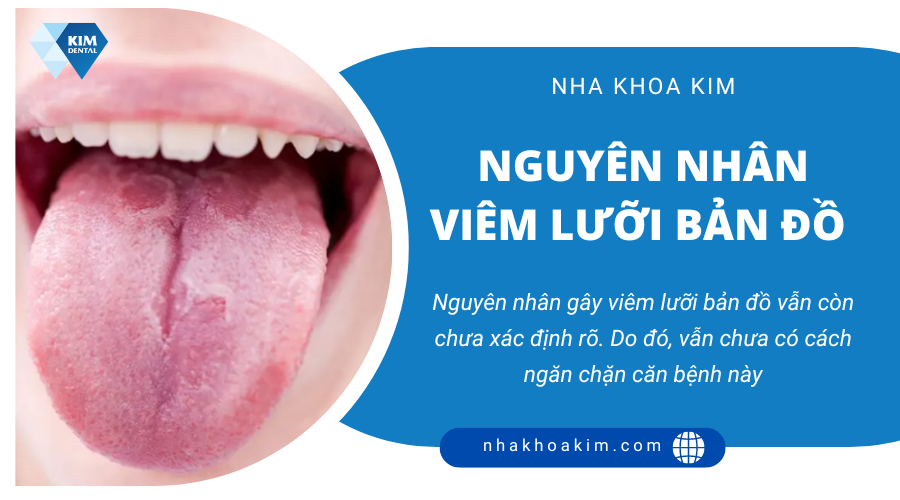 Nguyên nhân làm tăng nguy cơ viêm lưỡi bản đồ