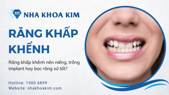 Răng khấp khểnh nên niềng, trồng implant hay bọc răng sứ tốt?