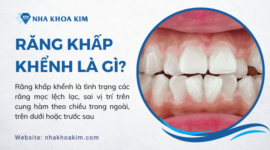 Răng khấp khểnh là gì?