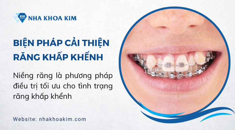 Giải pháp giúp cải thiện tình trạng răng khấp khểnh