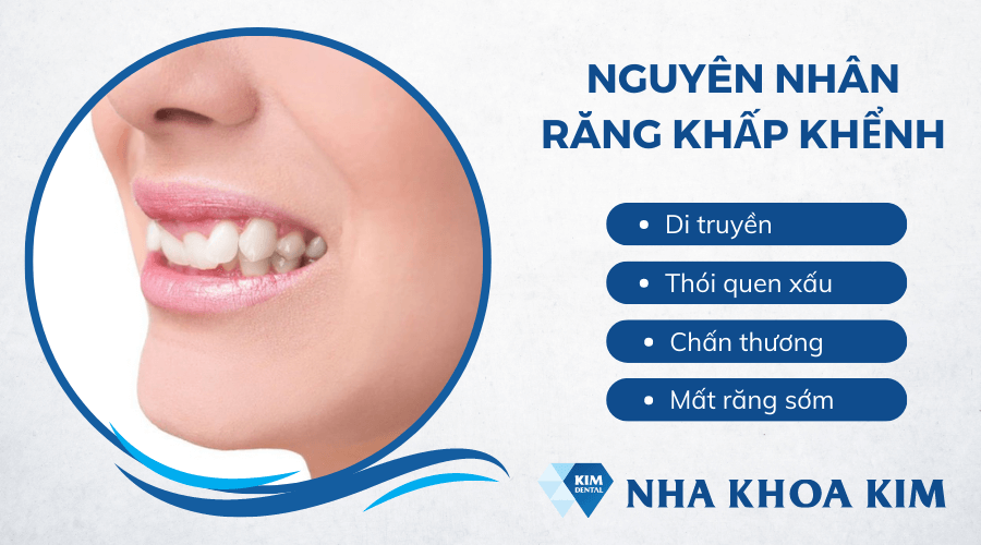 Nguyên nhân gây nên tình trạng răng khấp khểnh
