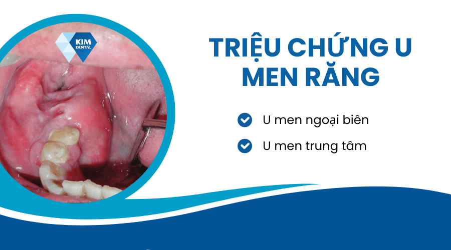 Triệu chứng u men răng