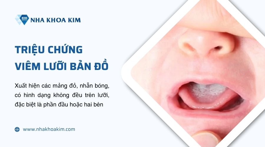 triệu chứng viêm lưỡi bản đồ