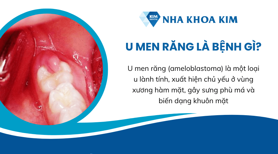 U men răng là bệnh gì?