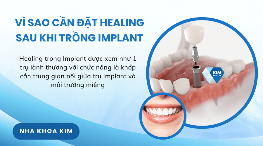 Vì sao cần đặt Healing sau khi trồng răng Implant