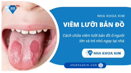 Viêm lưỡi bản đồ là gì? Nguyên nhân và cách trị