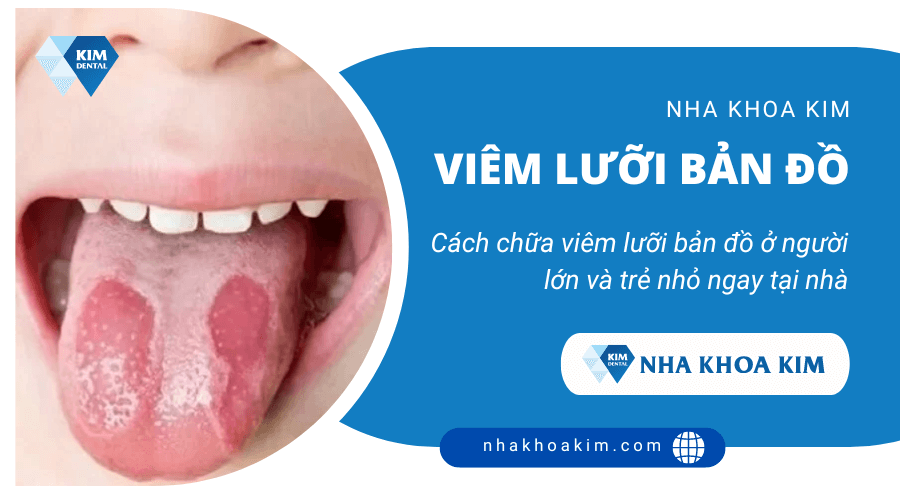 Nấm Lưỡi Bản Đồ Là Gì? Nguyên Nhân, Triệu Chứng Và Cách Điều Trị Hiệu Quả