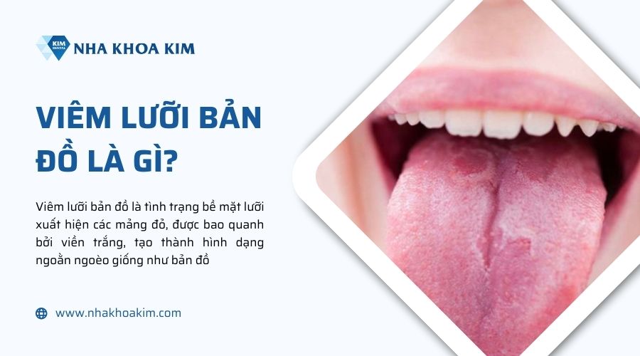 viêm lưỡi bản đồ là gì