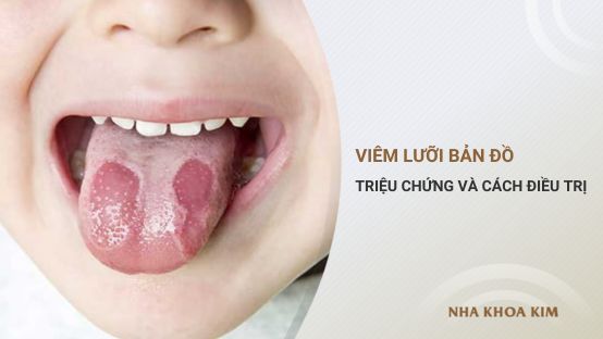 Viêm lưỡi bản đồ là gì? Nguyên nhân và cách trị