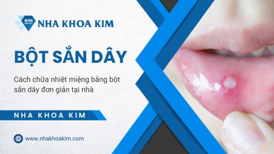 Cách chữa nhiệt miệng bằng bột sắn dây đơn giản tại nhà