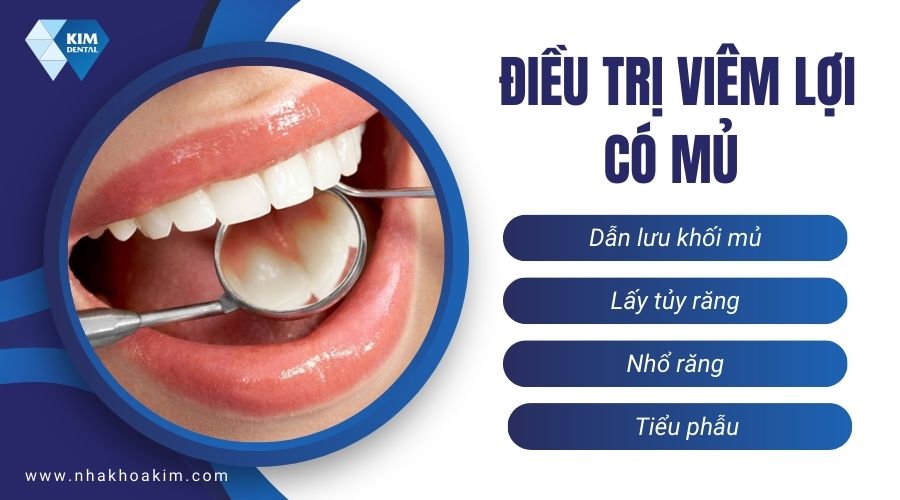 điều trị viêm lợi có mủ