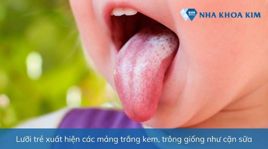 Hình ảnh trẻ bị nấm lưỡi có các mảng trắng kem