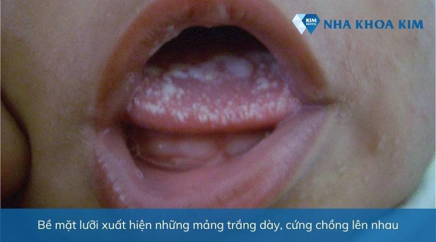 Bạch sản, tăng sản lưỡi