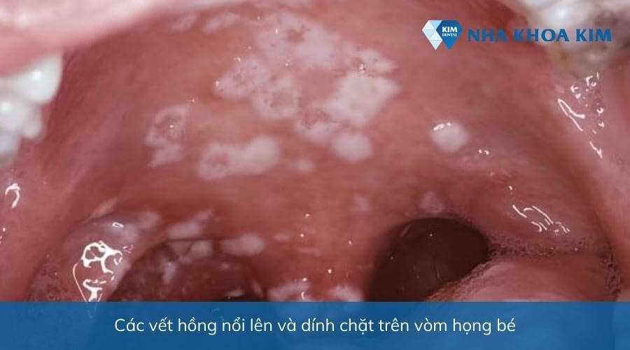 Hình ảnh nấm lưỡi Hồng ban ở vòm họng xuất hiện các vết hồng bám chặc trên vòm họng bé