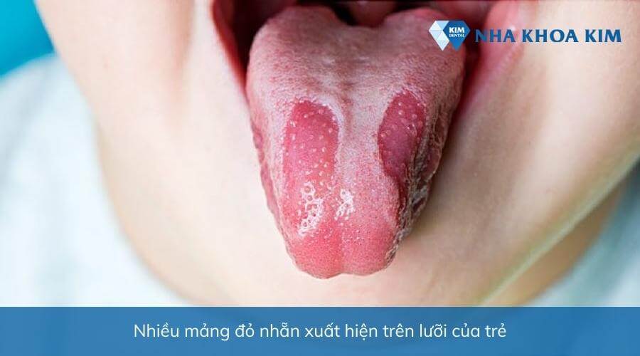 Hình ảnh viêm lưỡi bản đồ ở trẻ em