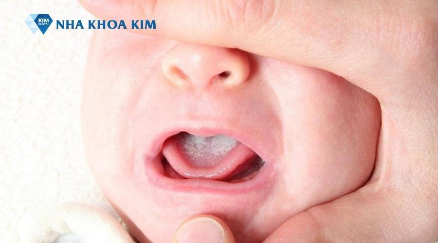 Hình ảnh nấm lưỡi dạng kem ở trẻ sơ sinh