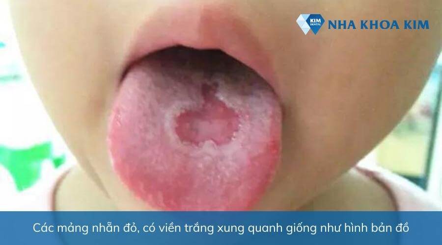 Viêm lưỡi bản đồ 