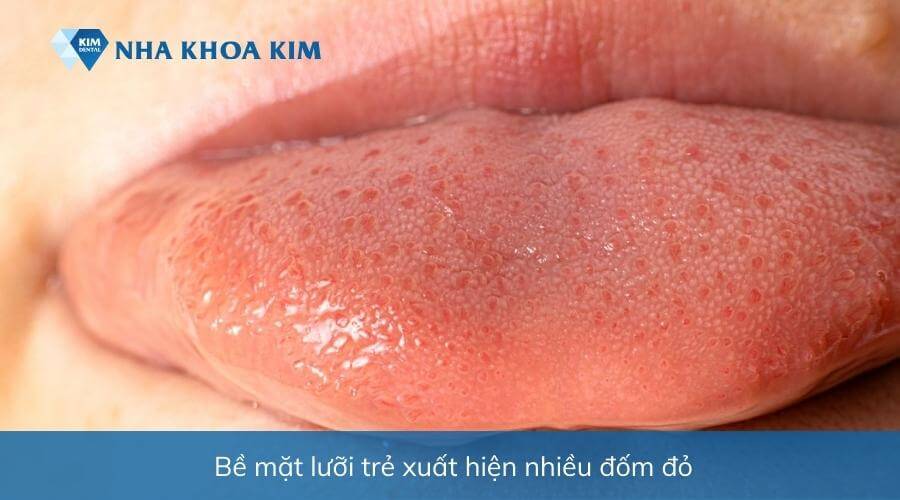 Hình ảnh bé bị nấm lưỡi gây sưng đỏ, đau rát