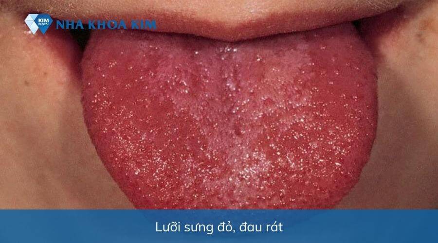 Hình ảnh nấm lưỡi gây sưng đỏ là nguyên nhân làm bé biếng ăn