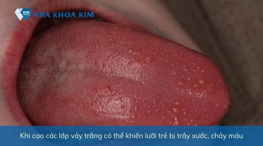 Hình ảnh nấm lưỡi ở trẻ sơ sinh kèm chảy máu